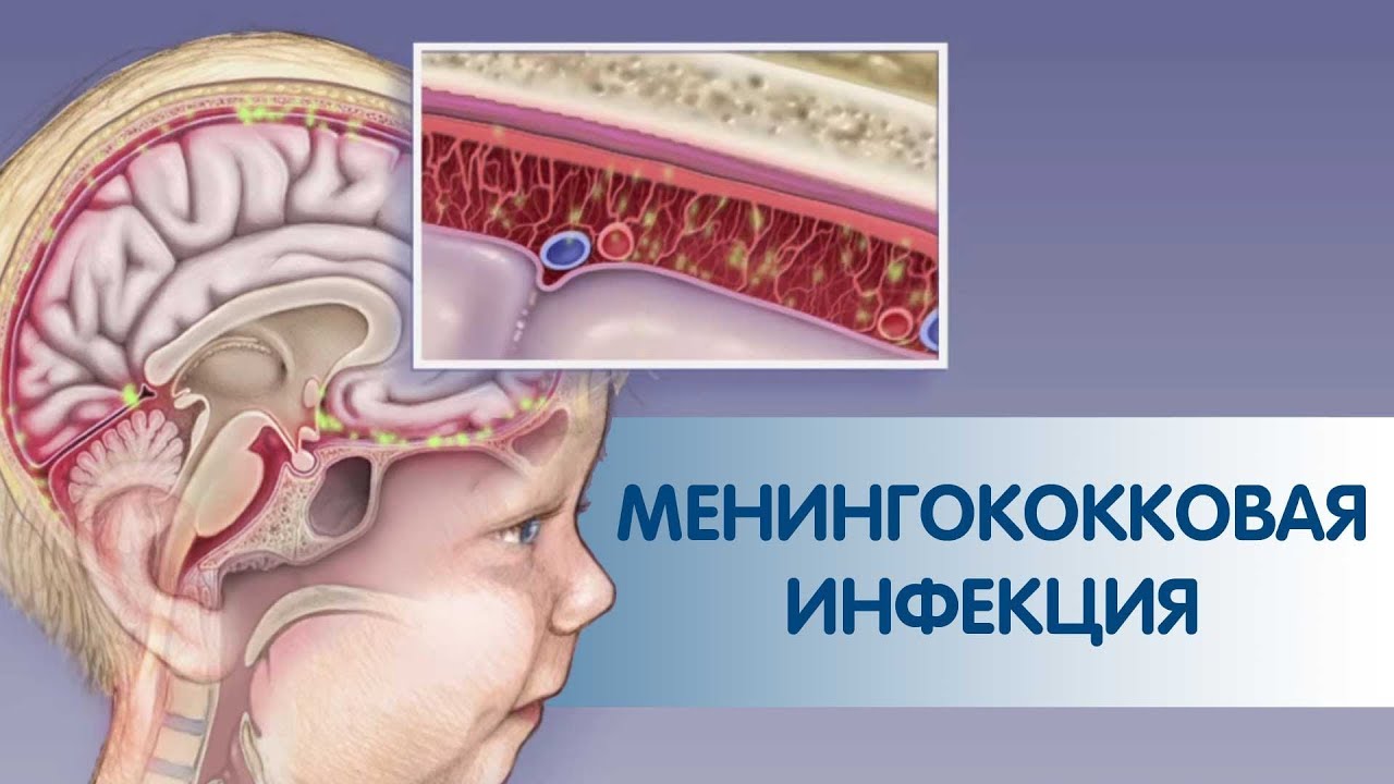 МЕНИНГОКОККОВАЯ ИНФЕКЦИЯ