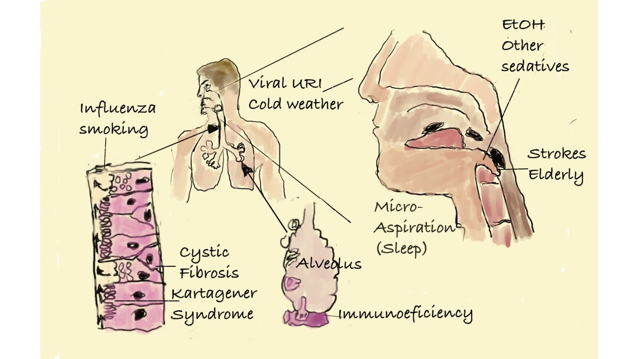 1. Community-acquired Pneumonia (CAP) Epidemiology and Pathogenesis