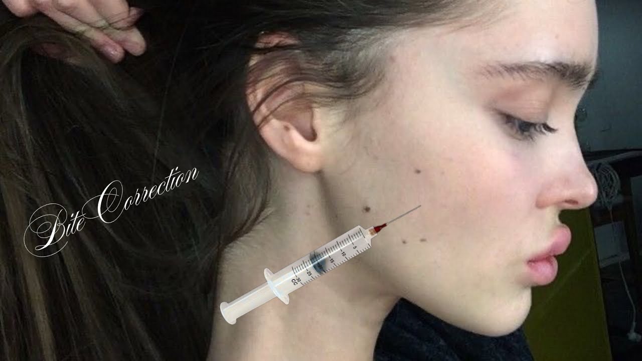experimental complete bite + side profile correction [💉] (1x MAX) ୨୧ ‧˚ 