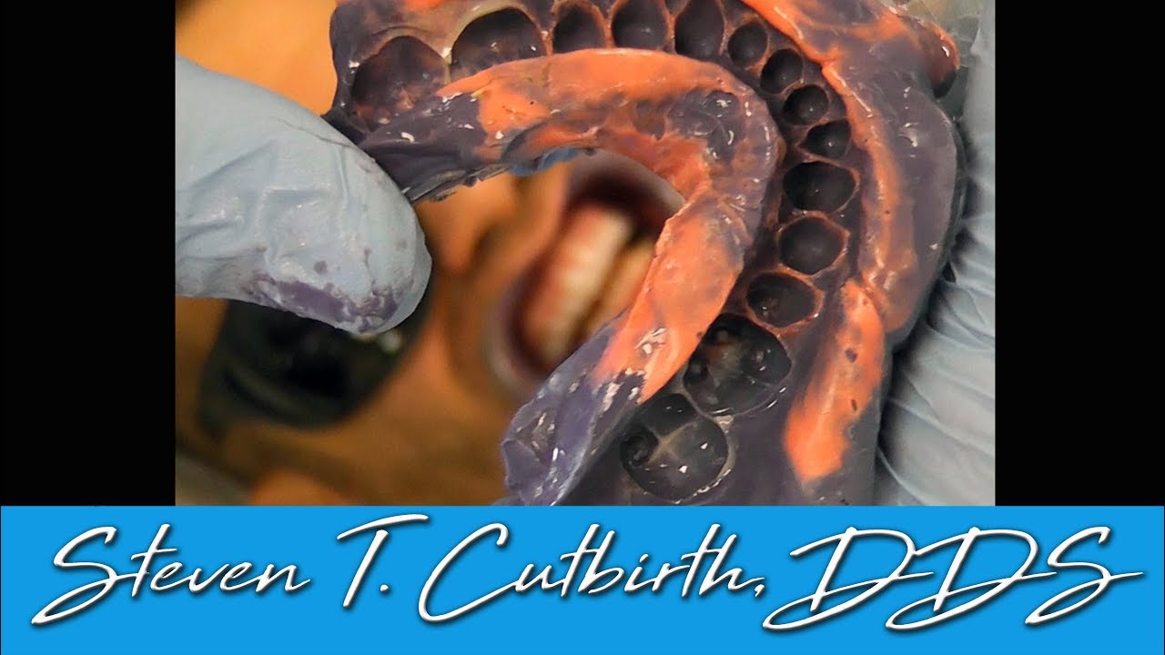 How to Take the Most Accurate Impression - Dental Minute with Steven T. Cutbirth, DDS
