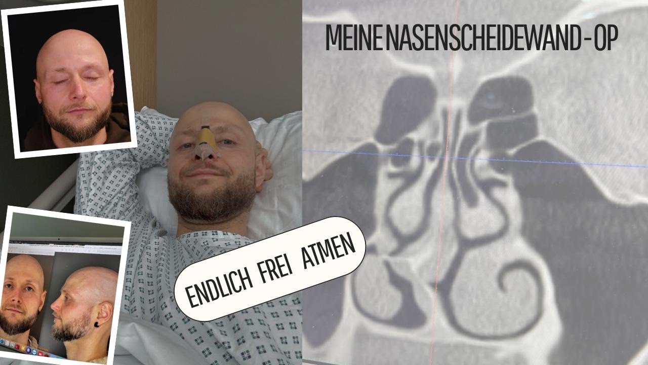 Nasenscheidewand OP (Septumplastik) – Meine ehrliche Erfahrung im Krankenhaus + Ptosis-OP Aussicht