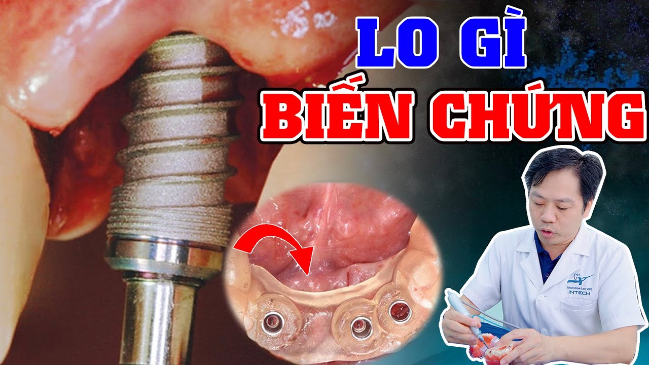 Công Nghệ Trồng Răng Mới Nhất: Chính Xác Đến Từng Milimet|Lo Gì Biến Chứng, Ngại Gì Sưng Đau