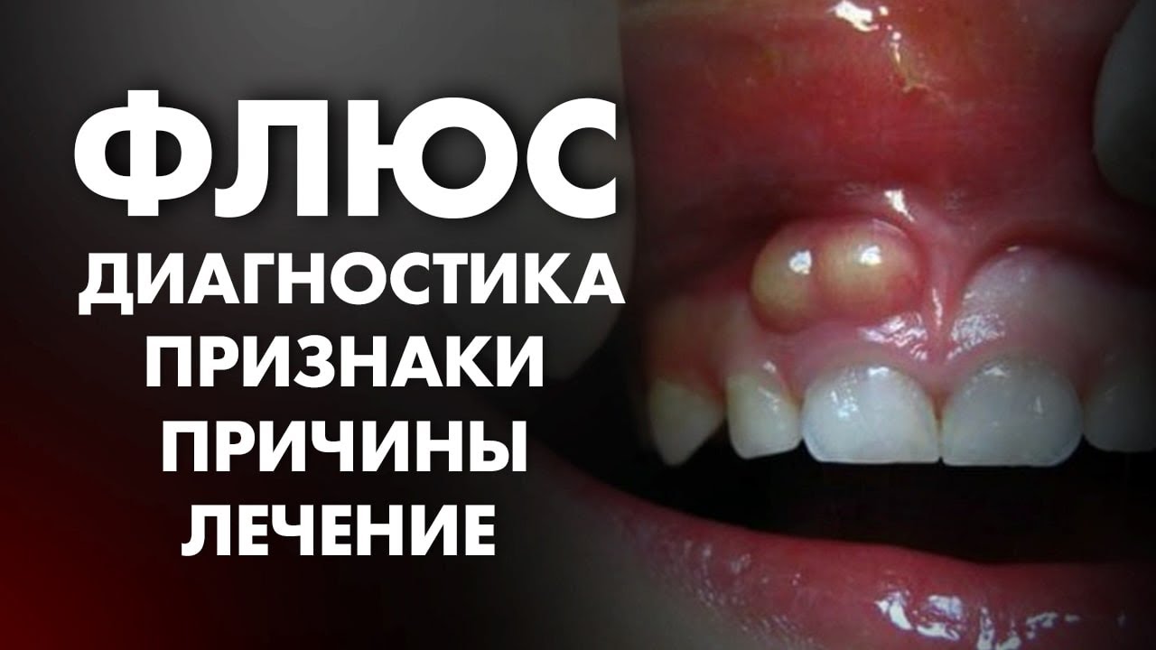 ФЛЮС: ПРИЗНАКИ, ПРИЧИНЫ, ДИАГНОСТИКА, ЛЕЧЕНИЕ ПЕРИОСТИТА | Клиника Online