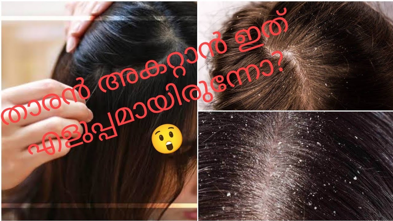 താരൻ പോകാൻ ഇത്രെയും നല്ല വഴി വേറെ ഇല്ല || How to remove dandruff in easy way |@sunithakitchen7719