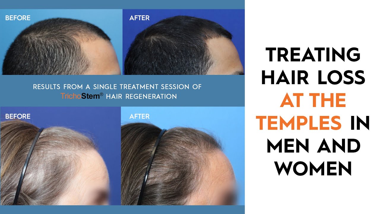 Causes and Treatments for Hair Loss in Temples