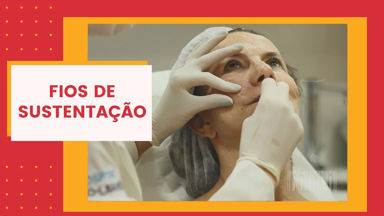 Fios de Sustentação. A aplicação passo-a-passo para estimular o colágeno do rosto. Antes e Depois.