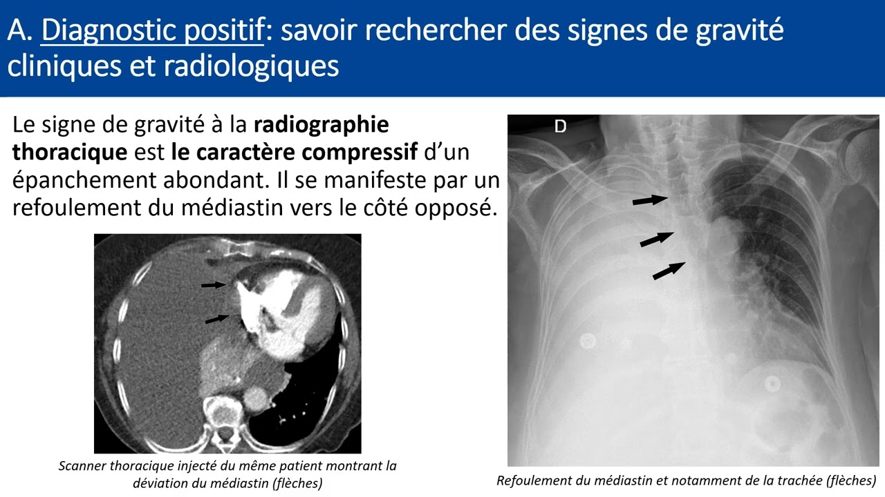 Item 206 Epanchement pleural liquidien