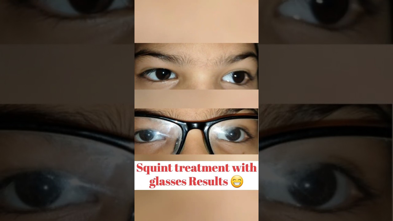 squint treatment in indore | role of eye glasses in squint