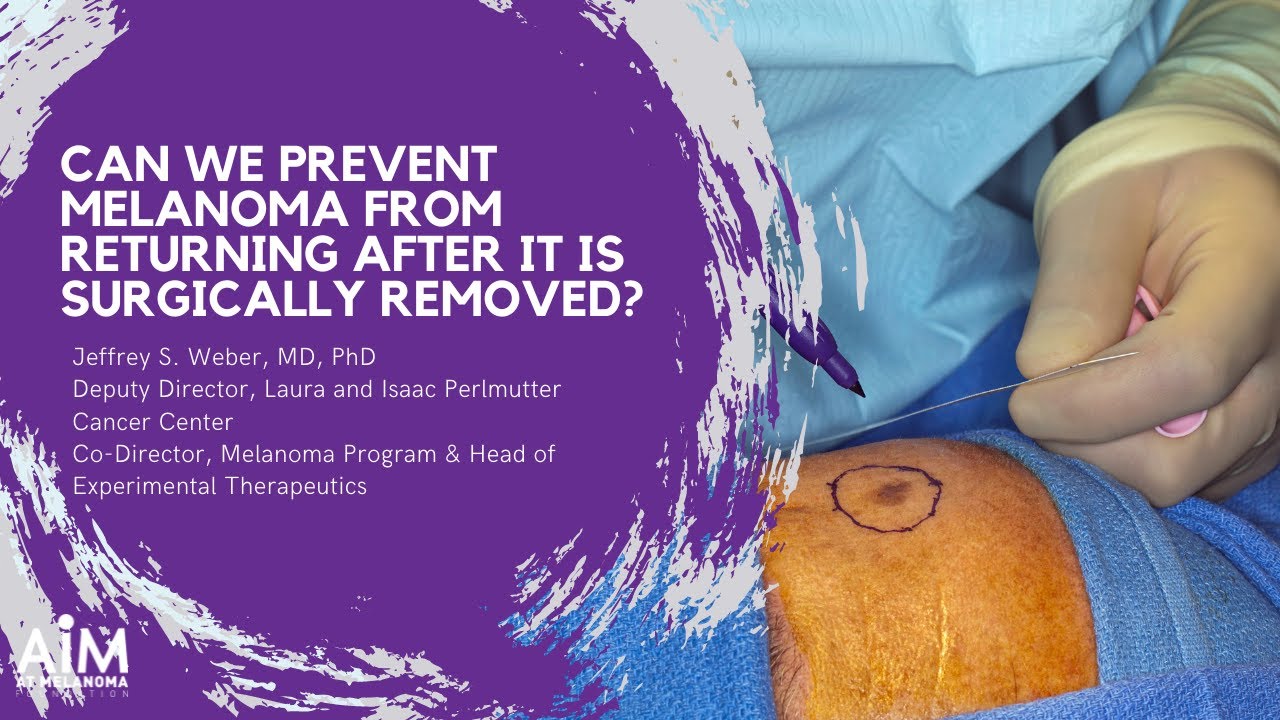 Can We Prevent Melanoma From Returning After It Is Surgically Removed?