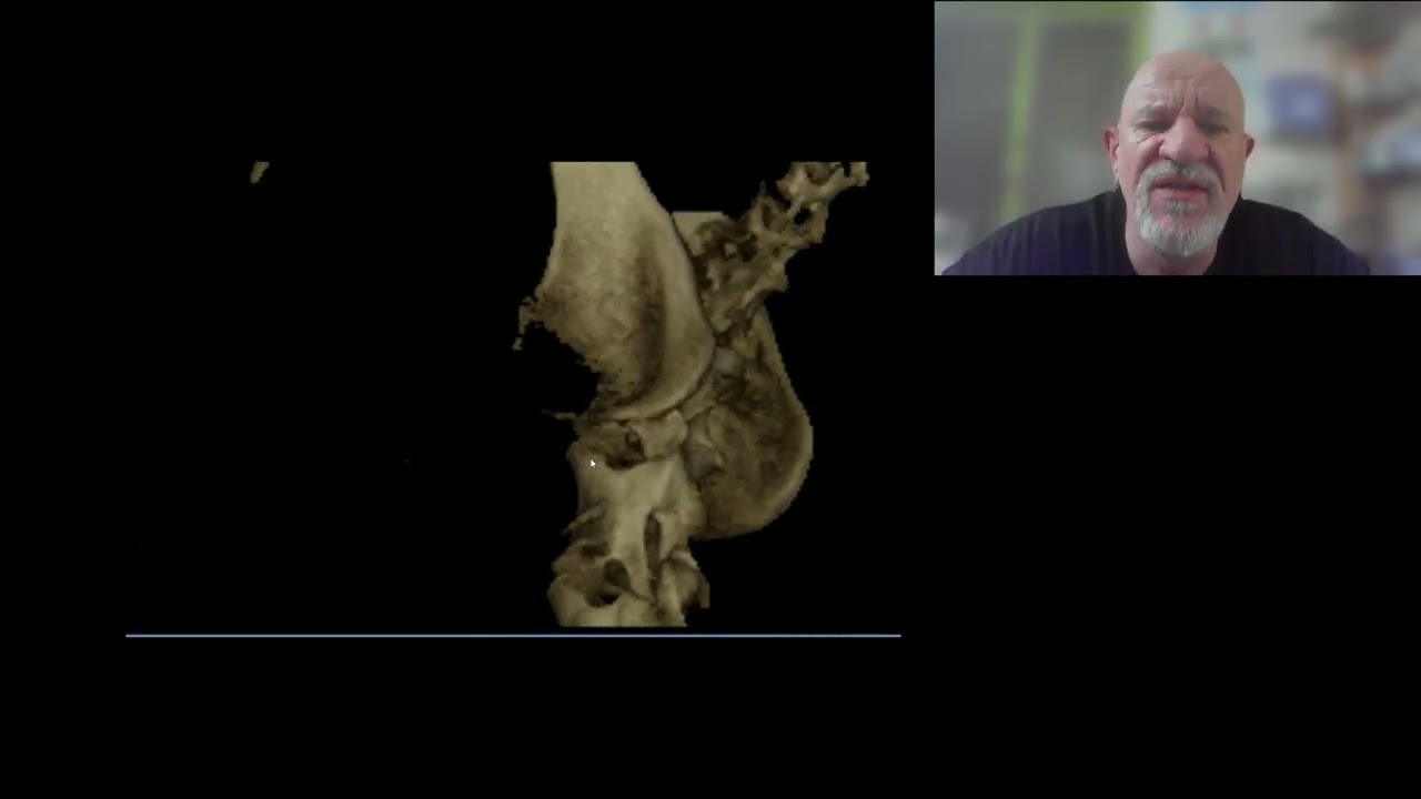 La segmentation 3D en chirurgie orthopédique vétérinaire