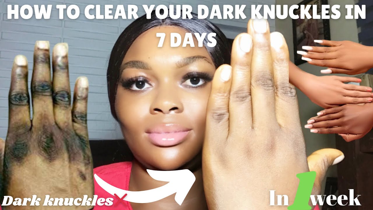 How To Clear Dark Knuckles In 7 Days Using 3 simple Products