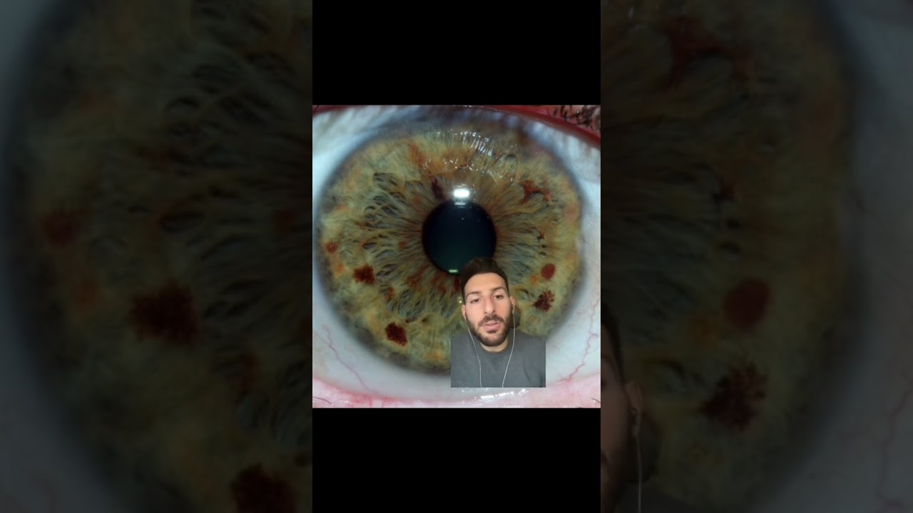 Iridology 101: Brown Pigments