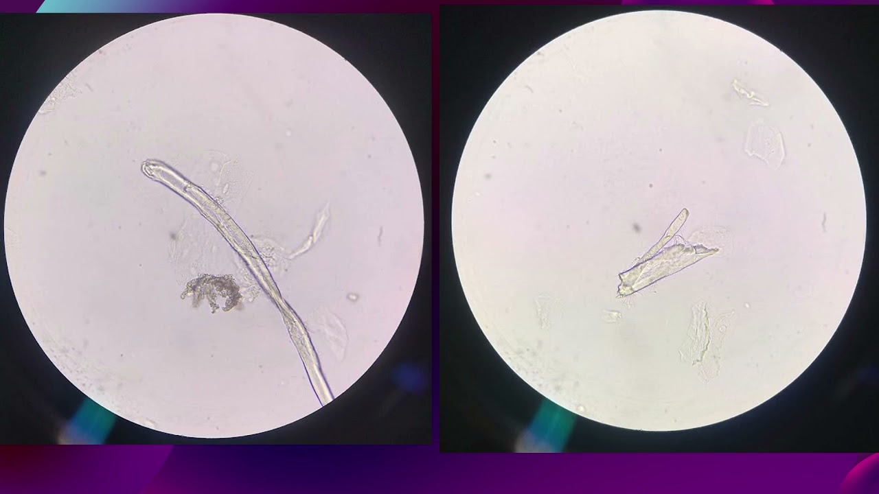 Sedimento Urinario en Microscopio | Con Asociación Clínica | 3a parte