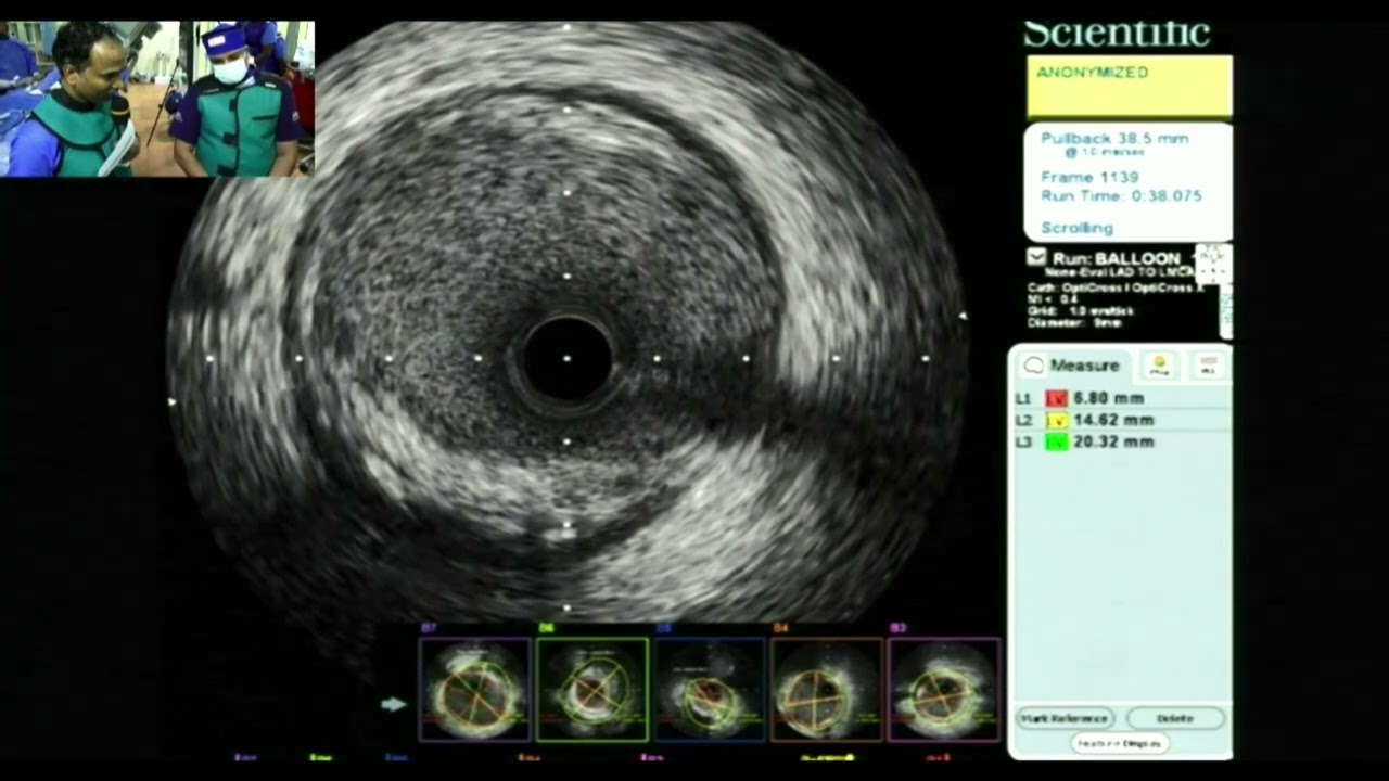 Bifurcation Live Case from Asiri Central Hospital - Singapore LIVE 2024