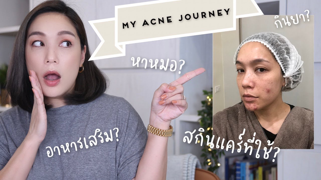 My Acne Journey บอกทุกสิ่งที่ทำ กิน ทา เพื่อซ่อมหน้าสิว | DAILYCHERIE