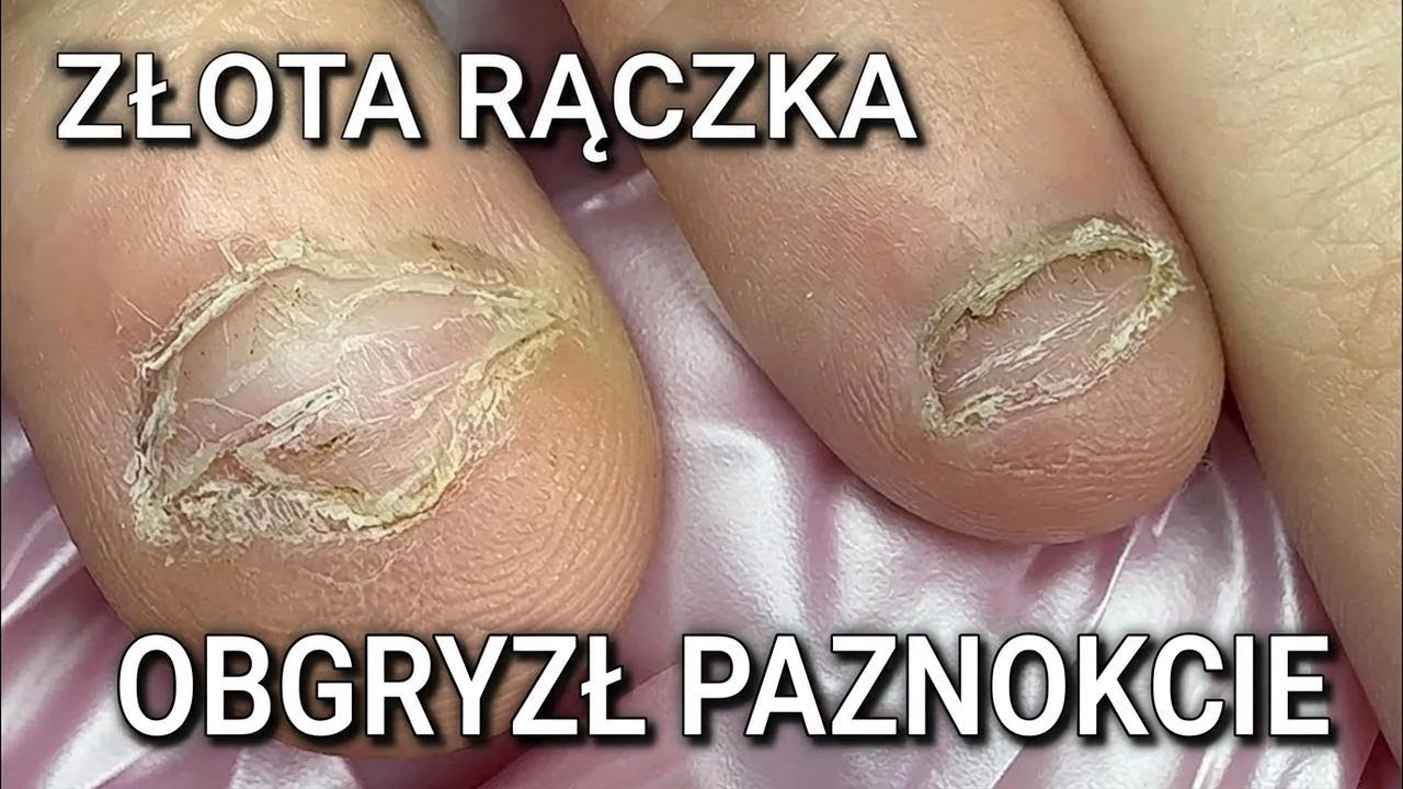 On pożera własne paznokcie – ogryzanie, onychofagia i męski manicure