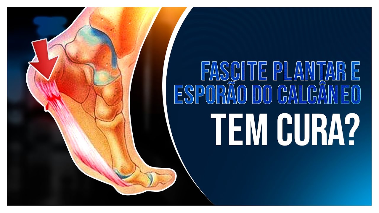 FASCITE PLANTAR E ESPORÃO DO CALCÂNEO TEM CURA? APRENDA NESSE VÍDEO!