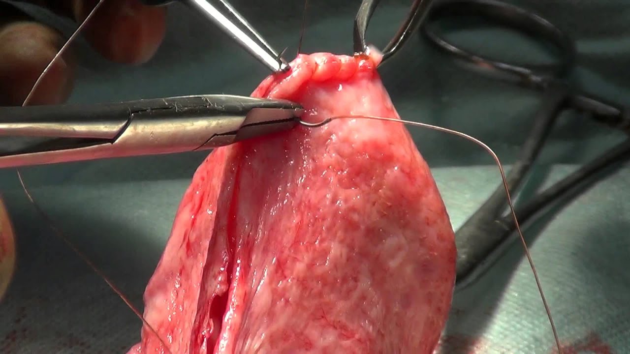 Hydrocele
