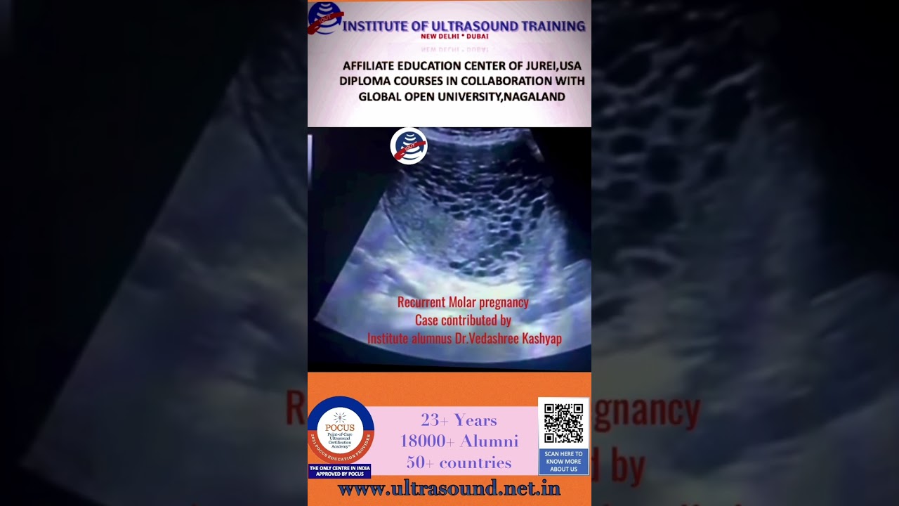 #Molar pregnancy #ultrasoundtraining #ultrasoundcourse