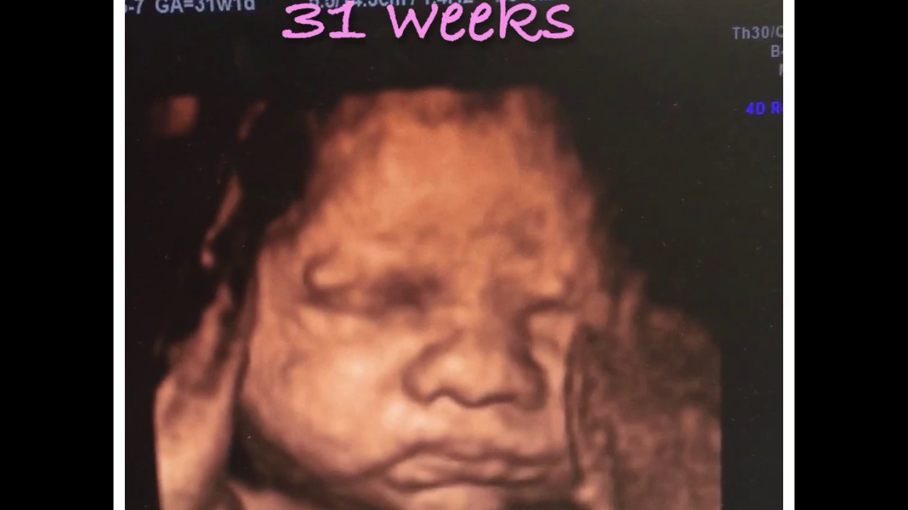 31 Week 4D Ultrasound