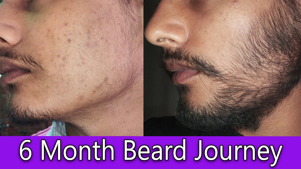 🤯Beard Growth SECRET Revealed | 6-Month Minoxidil + Derma Roller Journey| big difference| TIMELAPSE