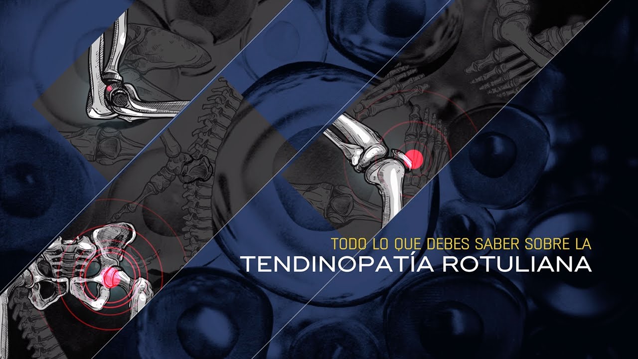 ¿Qué es la Tendinopatía Rotuliana?¿Cómo se produce y cómo se trata sin cirugía?