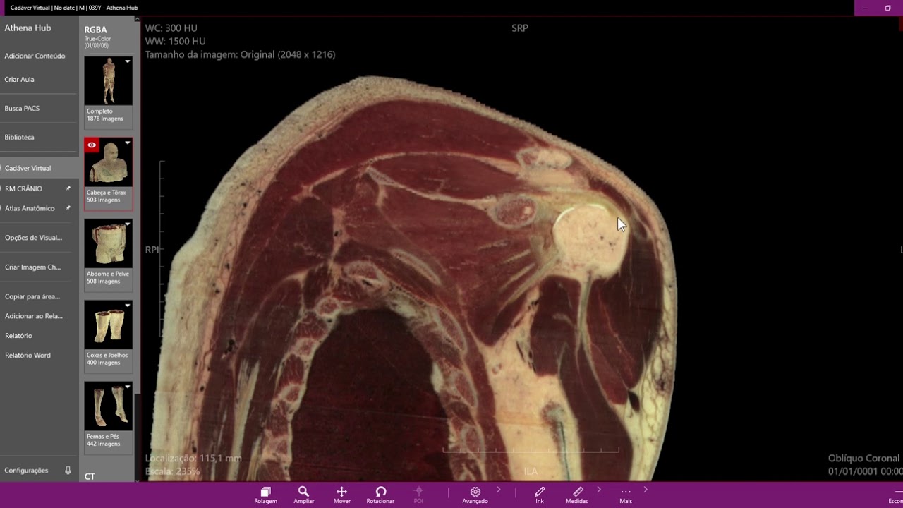 Anatomia radiol&oacute;gica - Tend&atilde;o supraespinhal