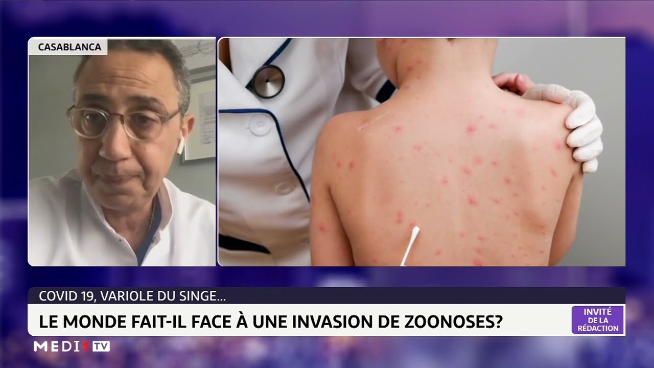 Covid-19-Variole du singe: le Maroc fait-il face &agrave; une invasion de zoonoses ?