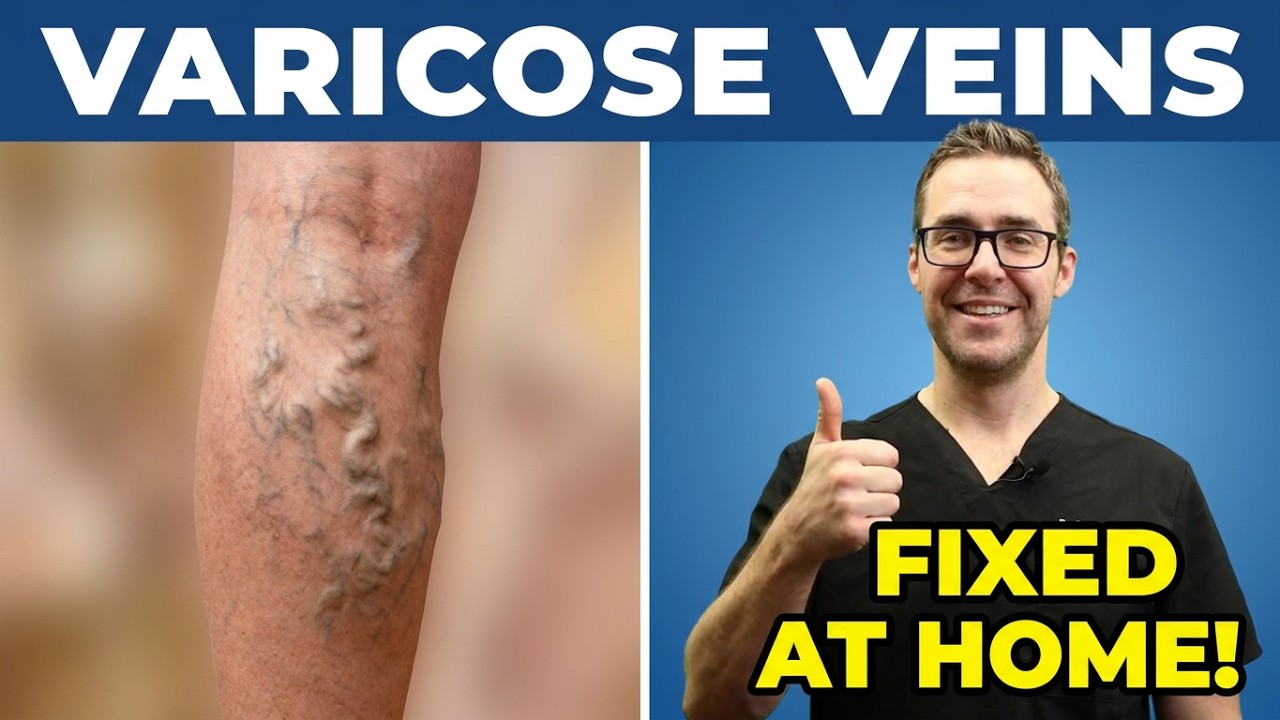 Best Varicose Vein Home Treatments! [Top 25 Spider Veins Remedies]