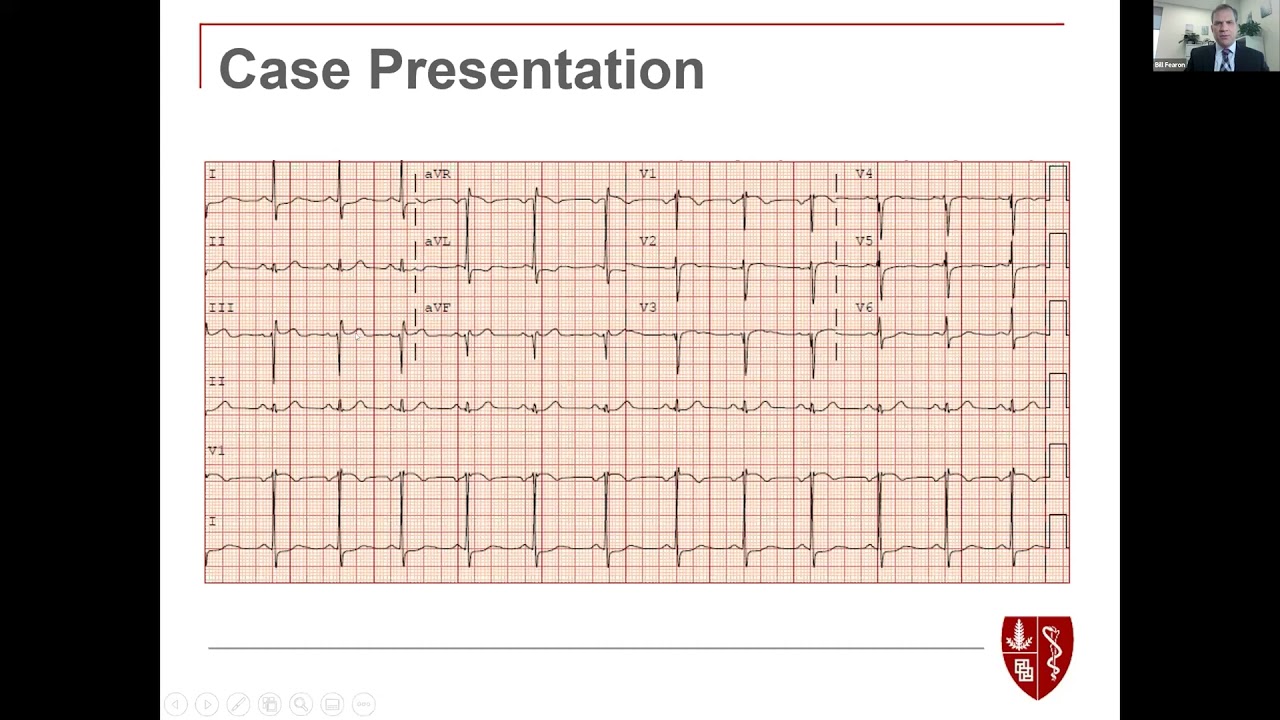 PCI or CABG for Multivessel Coronary Disease? The FAME 3 Trial  | DoM Grand Rounds | 5 Jan 2022