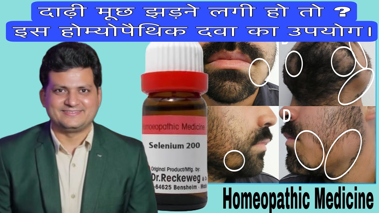 दाढ़ी मूछ झड़ने लगी होतो इस Homeopathic Medicine का इस्तेमाल करने से ठीक हो जाएगा ?