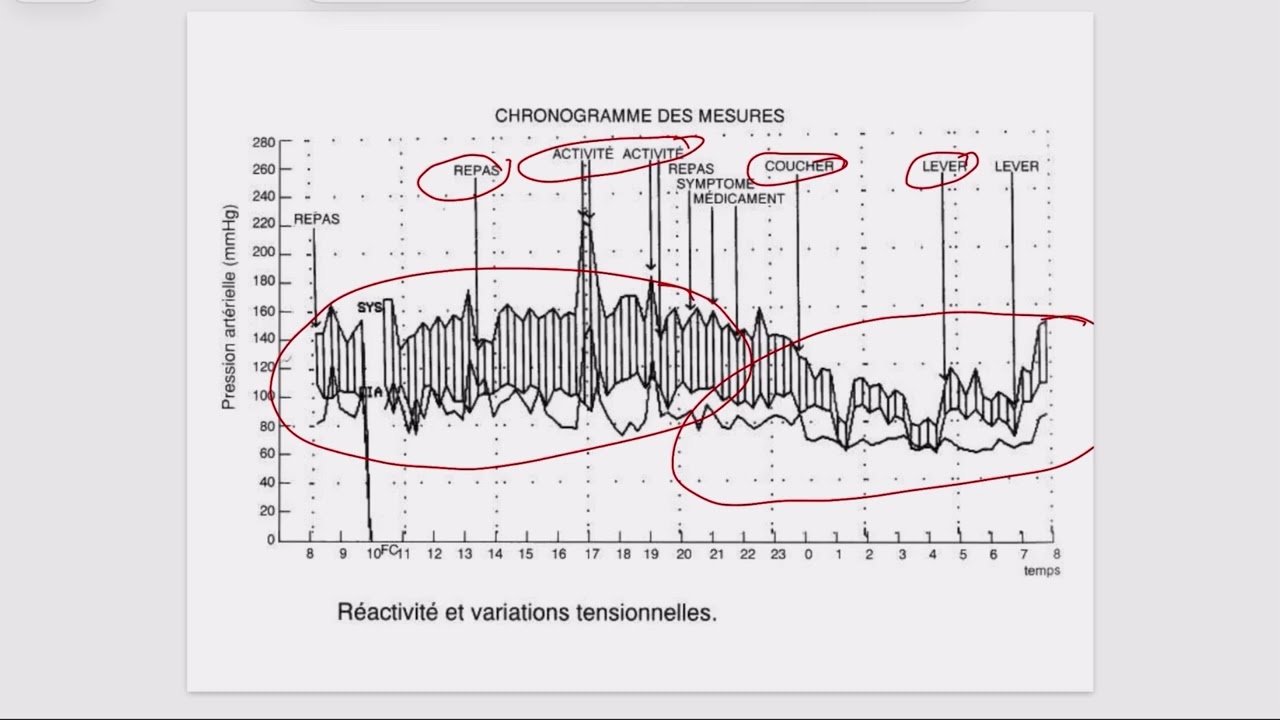 🔴 Extrait de séance en direct — Objectif 38 : Hypertension artérielle