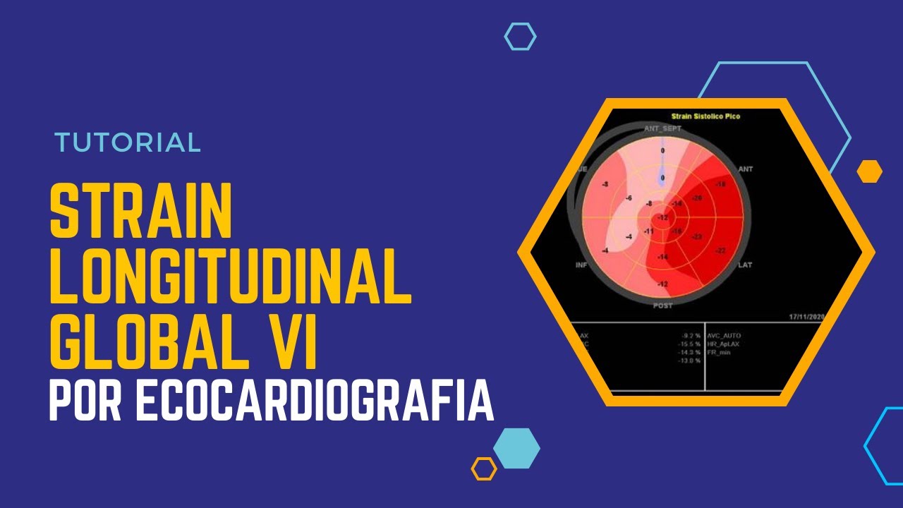 💹STRAIN LONGITUDINAL GLOBAL VI 🔊[Ecocardiografía]