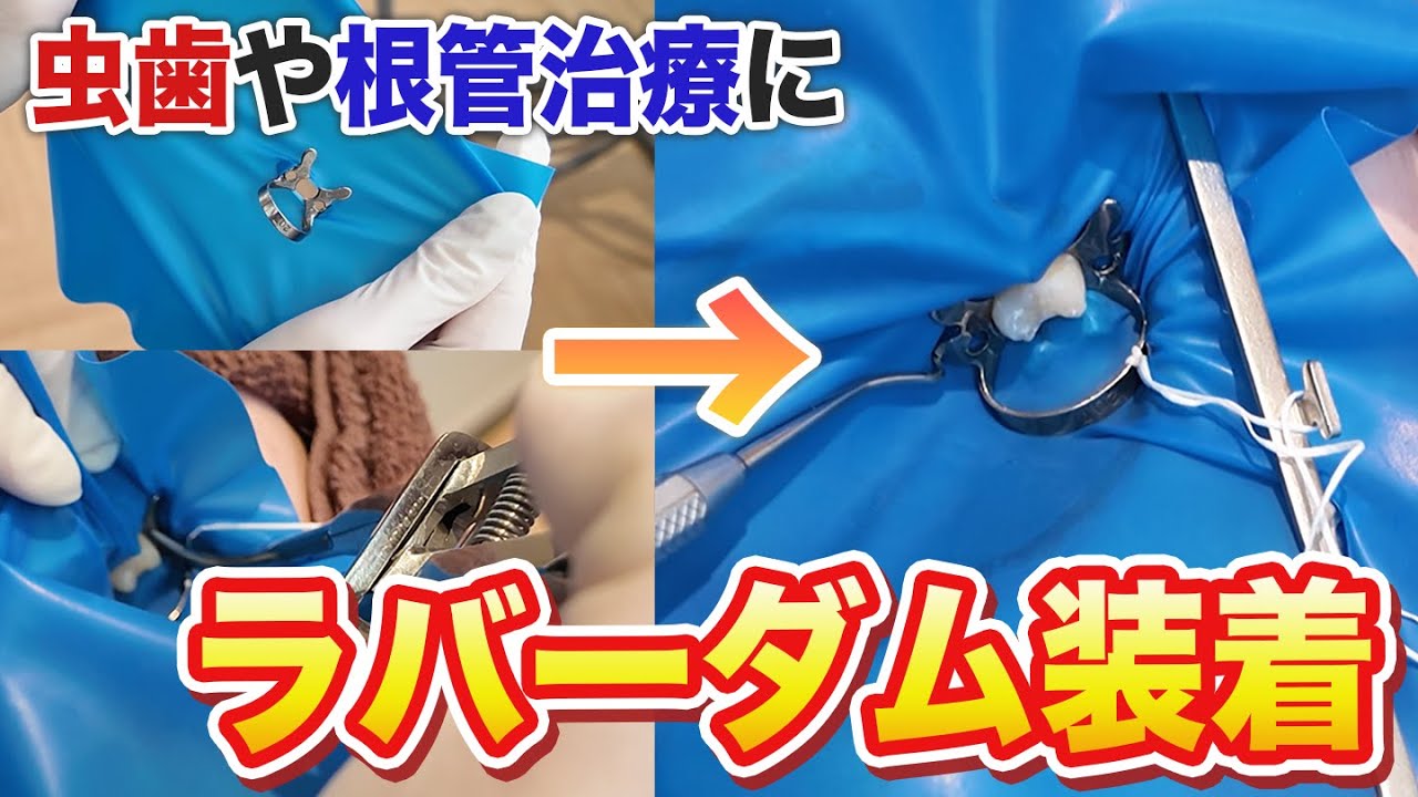虫歯や根管治療に使用されるラバーダムの装着手順！細菌予防や防湿に【名古屋茶屋歯科・矯正歯科】