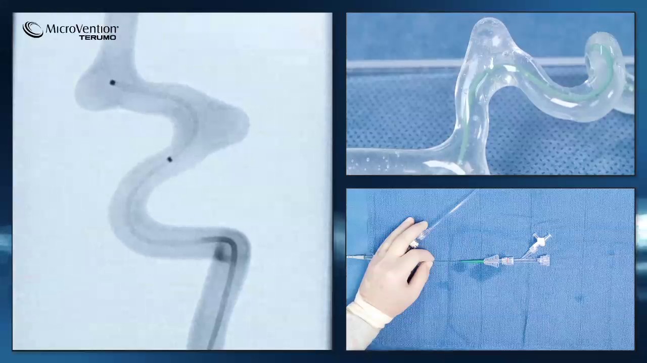 FRED Microcatheter Positioning Prior to Stent Deployment MV App