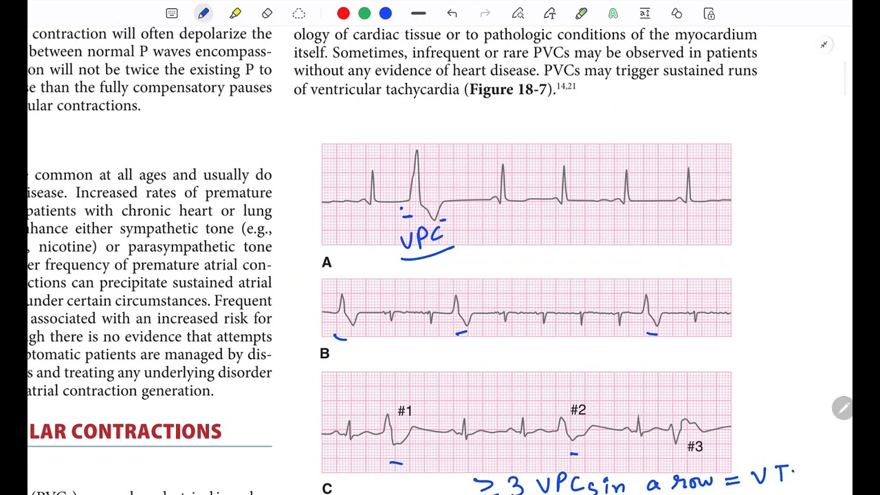 Arrhythmia 2