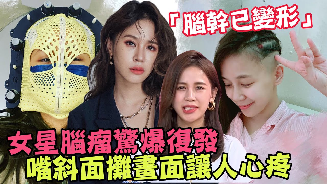 女星腦瘤驚爆復發「腦幹已變形」嘴斜面攤畫面讓人心疼   陳筱蕾愛情故事感動眾人，腦瘤徵兆有哪些？