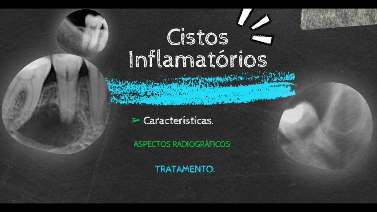 Cistos Inflamatórios Odontogênicos