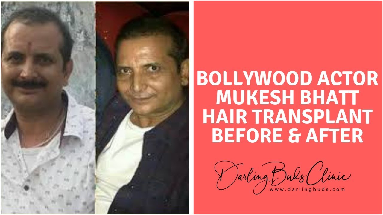 Bollywood Actor MUKESH BHATT Result after 2 Years of Hair Transplant