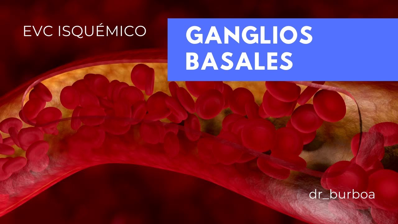 EVC ISQUÉMICO EN GANGLIOS BASALES