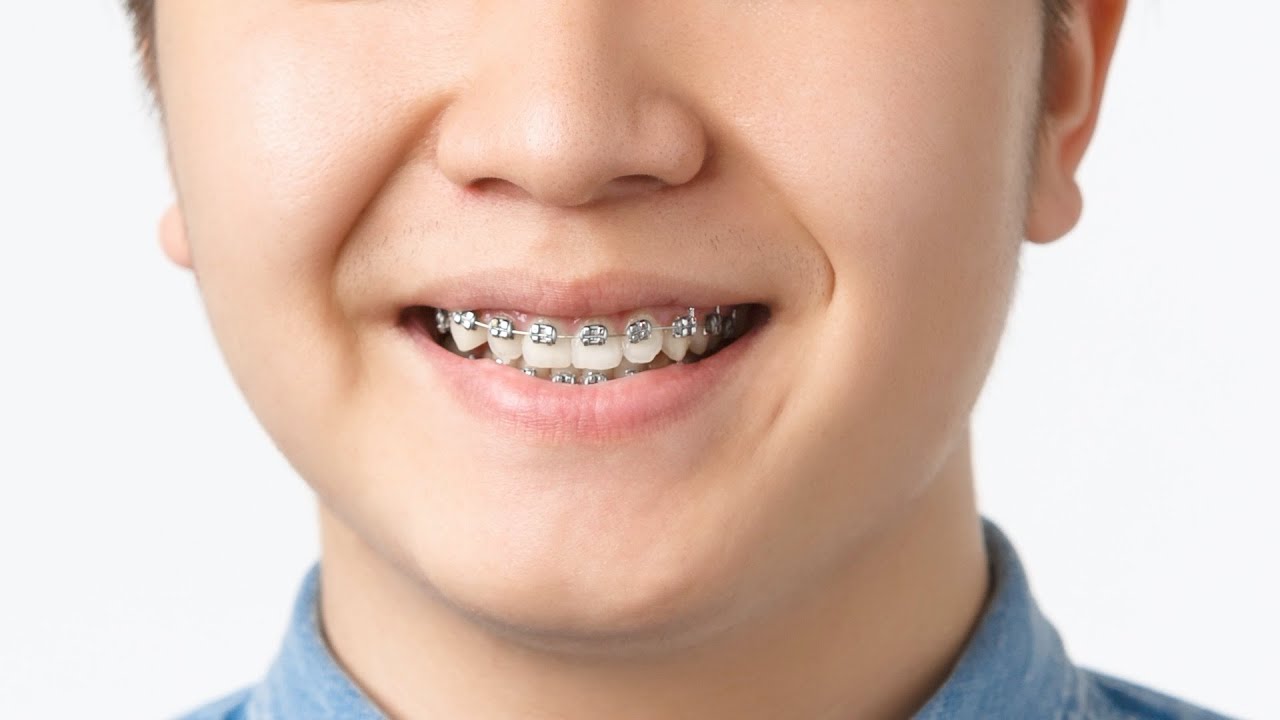إزاي التقويم بيظبط الأسنان؟