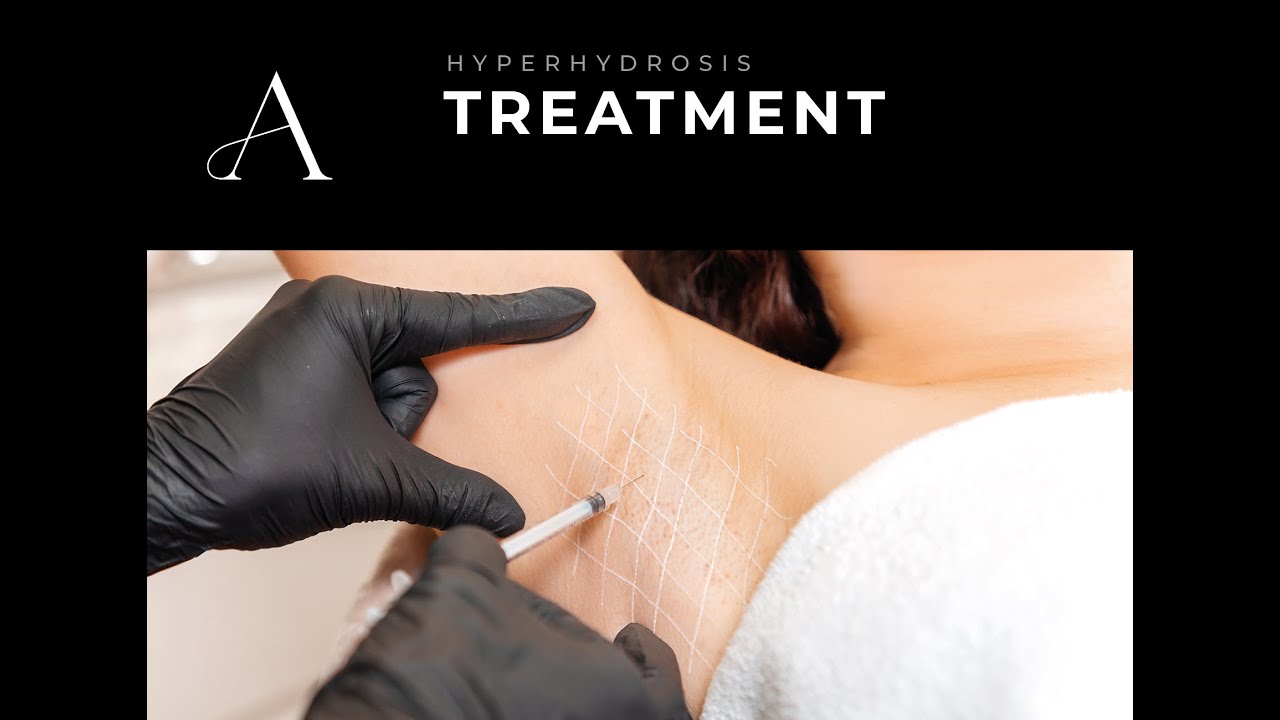 Hyperhydrosis - Underarm Treatment for Excessive Sweating
