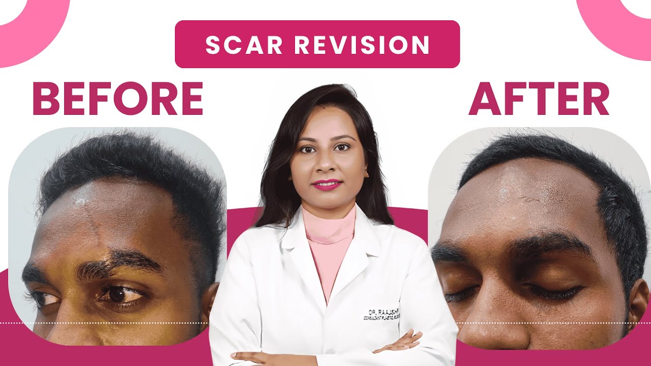Permanent Scar removal - Scar revision Surgery. How to get rid of facial scar? 