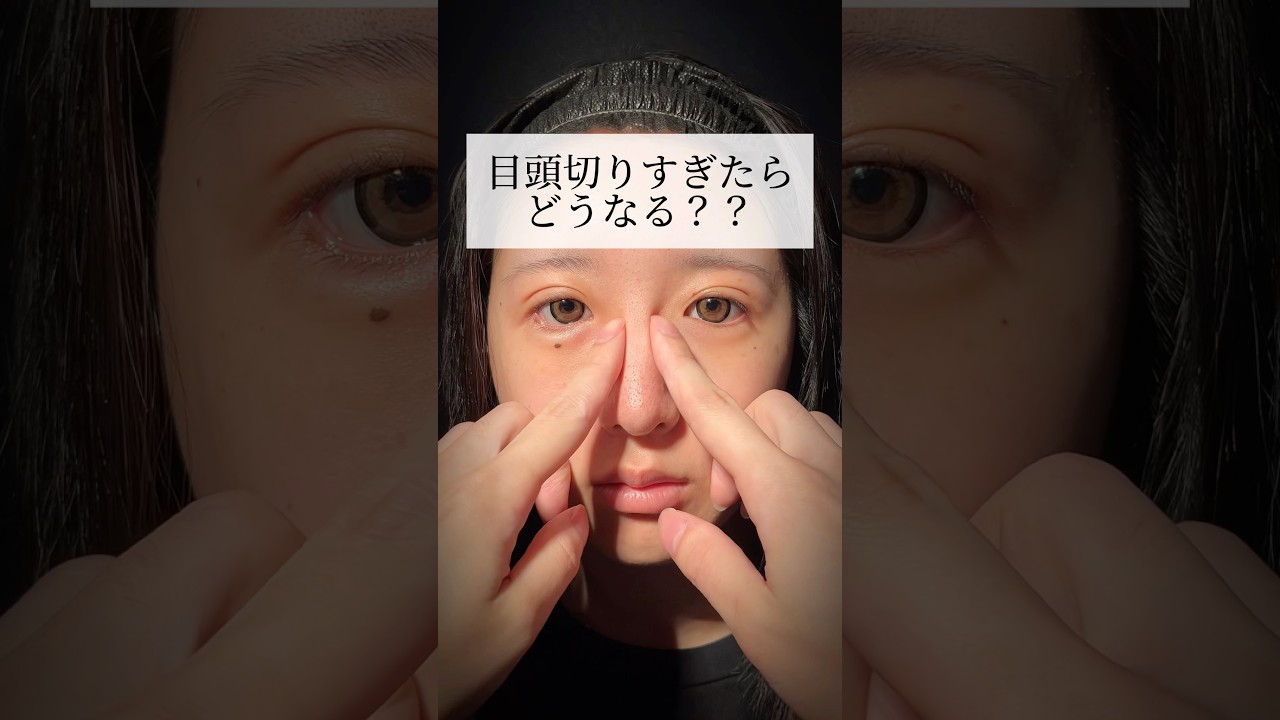 目頭を切り過ぎたらどうなる？？#shorts #二重整形 #目頭切開 #ダウンタイム #整形 #東京 #池袋 #蒙古襞