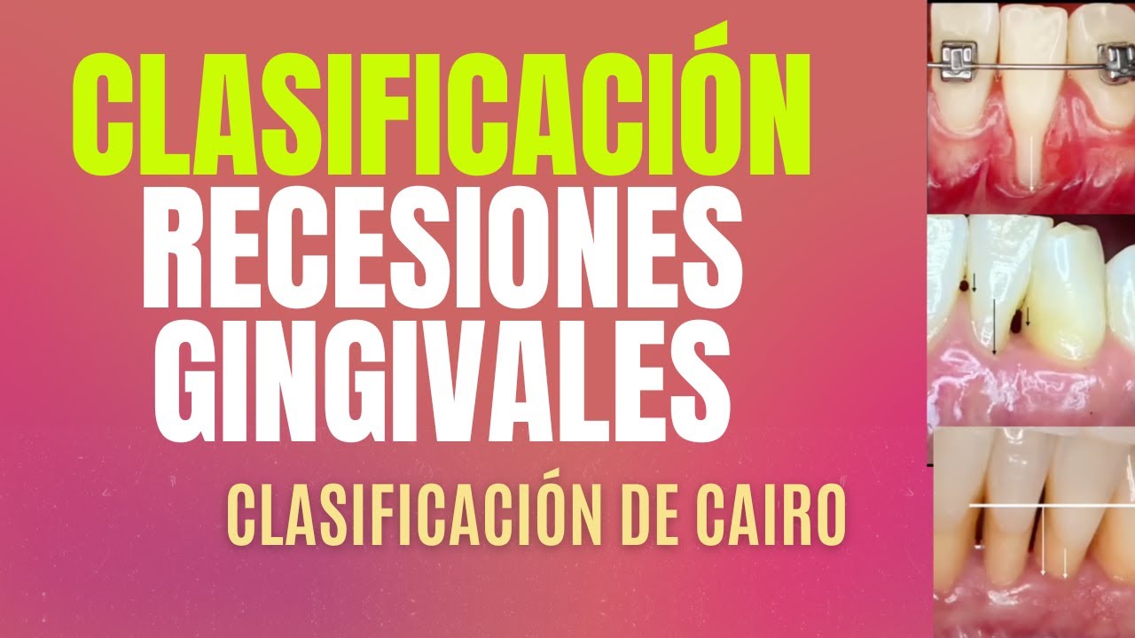Clasificación Recesiones Gingivales 🦷 Clasificación de Cairo
