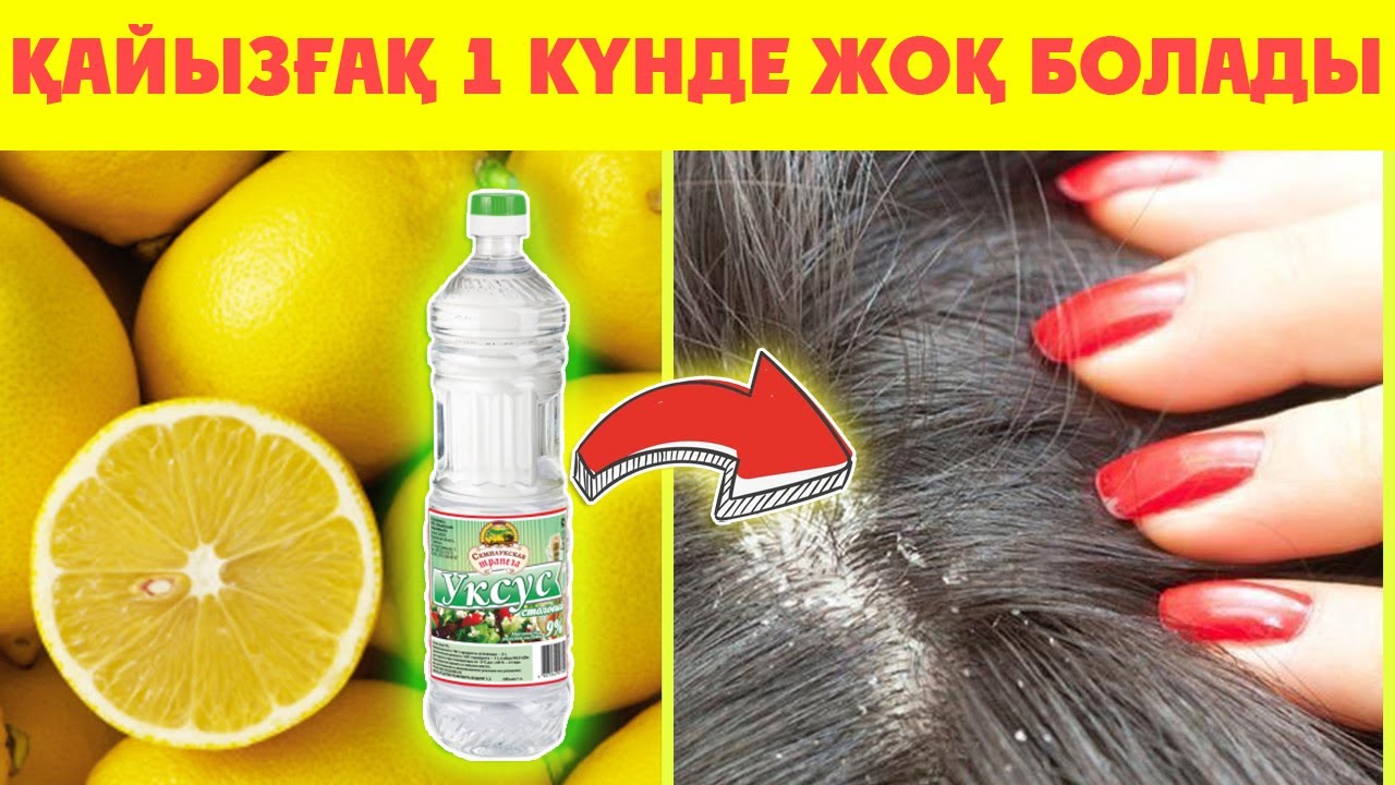 Лимон Қайызғақты Кетіреді, Шаштағы қайызғақтан арылу жолдары, Керек арнасы