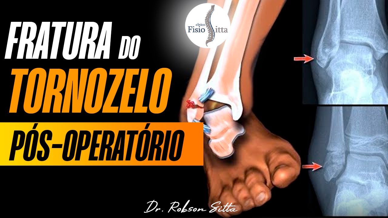 TRATAMENTO PÓS OPERATÓRIO FRATURA do MALÉOLO LATERAL do TORNOZELO - Fisioterapia Dr. Robson Sitta