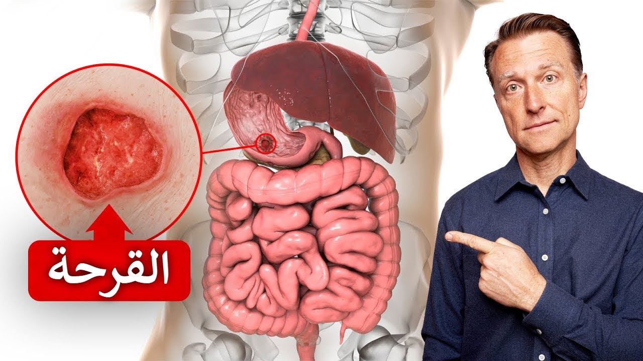 أسرع طريقة لعلاج القرحة بشكل نهائي
