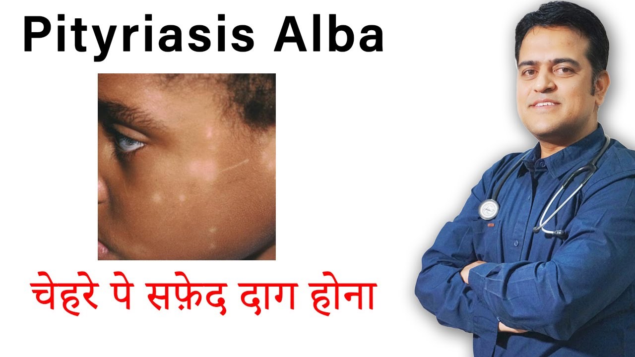 Treatment of pityriasis alba | Spots on face | How to clean marks of face | चेहरे पर सफ़ेद दाग |