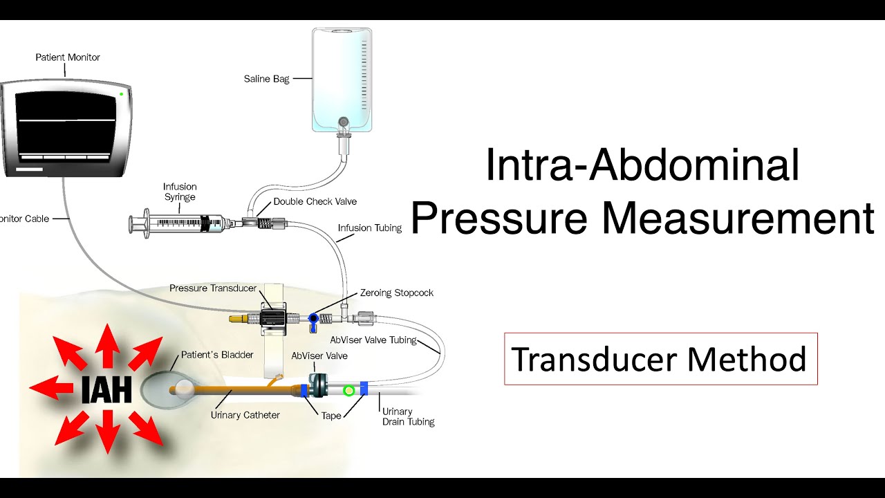 Intra-abdominal Pressure Measurement  II  Cough Test for IAP  II  ICU Bedside Procedure
